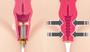 Tratamento com Laser Íntimo. Mais Qualidade de Vida Feminina - Dr. Carlos Moraes - Ginecologista e Obstetra